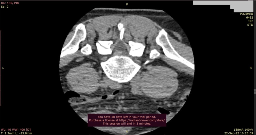 CT image from the Regina Maria lumbar injection sessions Stefan Mindea
