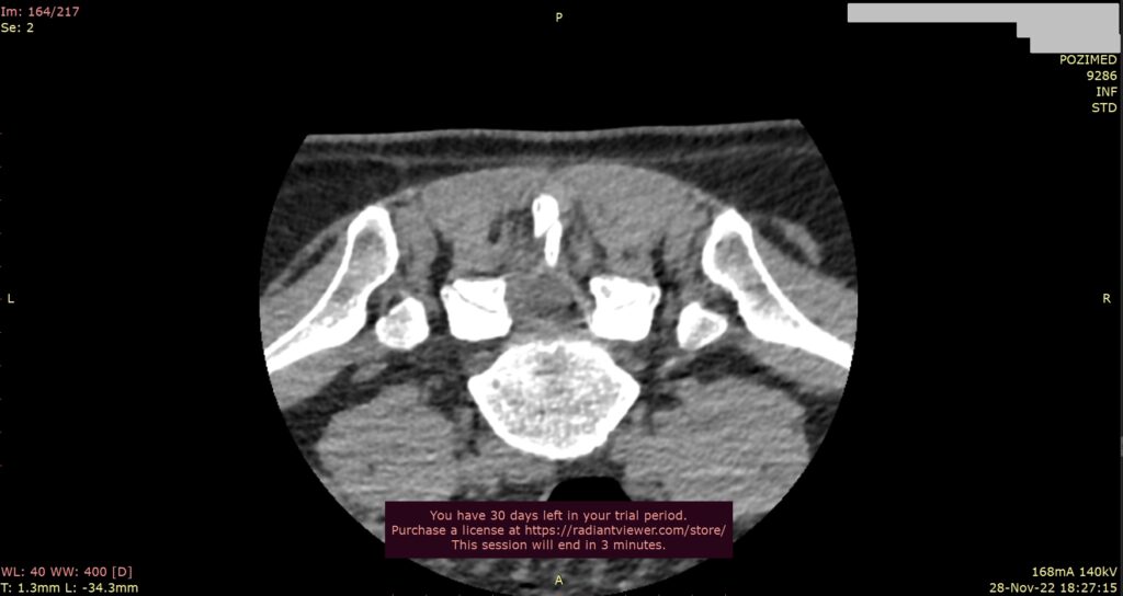 CT image from the Regina Maria lumbar injection sessions Stefan Mindea